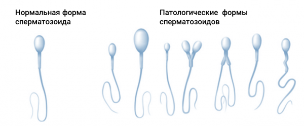 Нормальное строение сперматозоида и аномалии