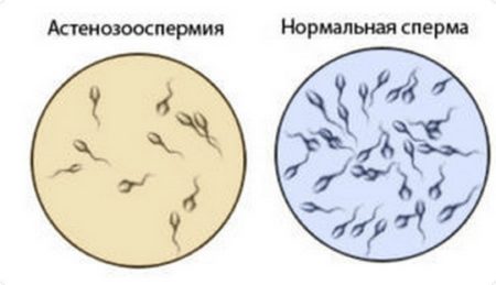 Астенозооспермия и нормальная сперма