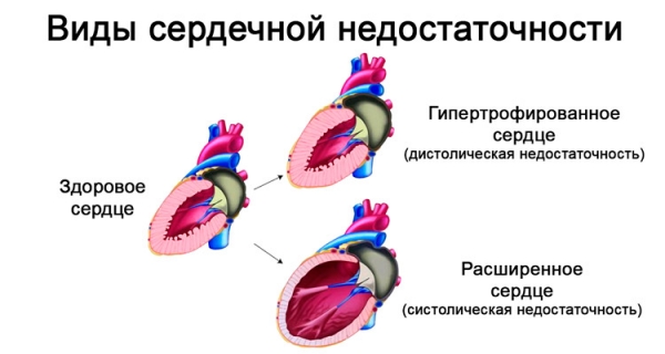 Сердечная недостаточность - противопоказание к приему препарата