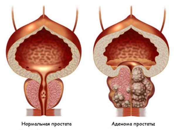 Аденома предстательной железы 
