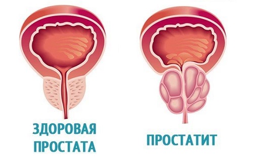 Здоровая простата
